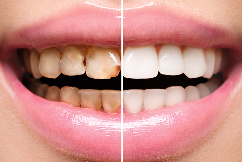 Get high-quality dental restorations in Pulaski for a healthier, confident smile. Looking for dental restorations near you?